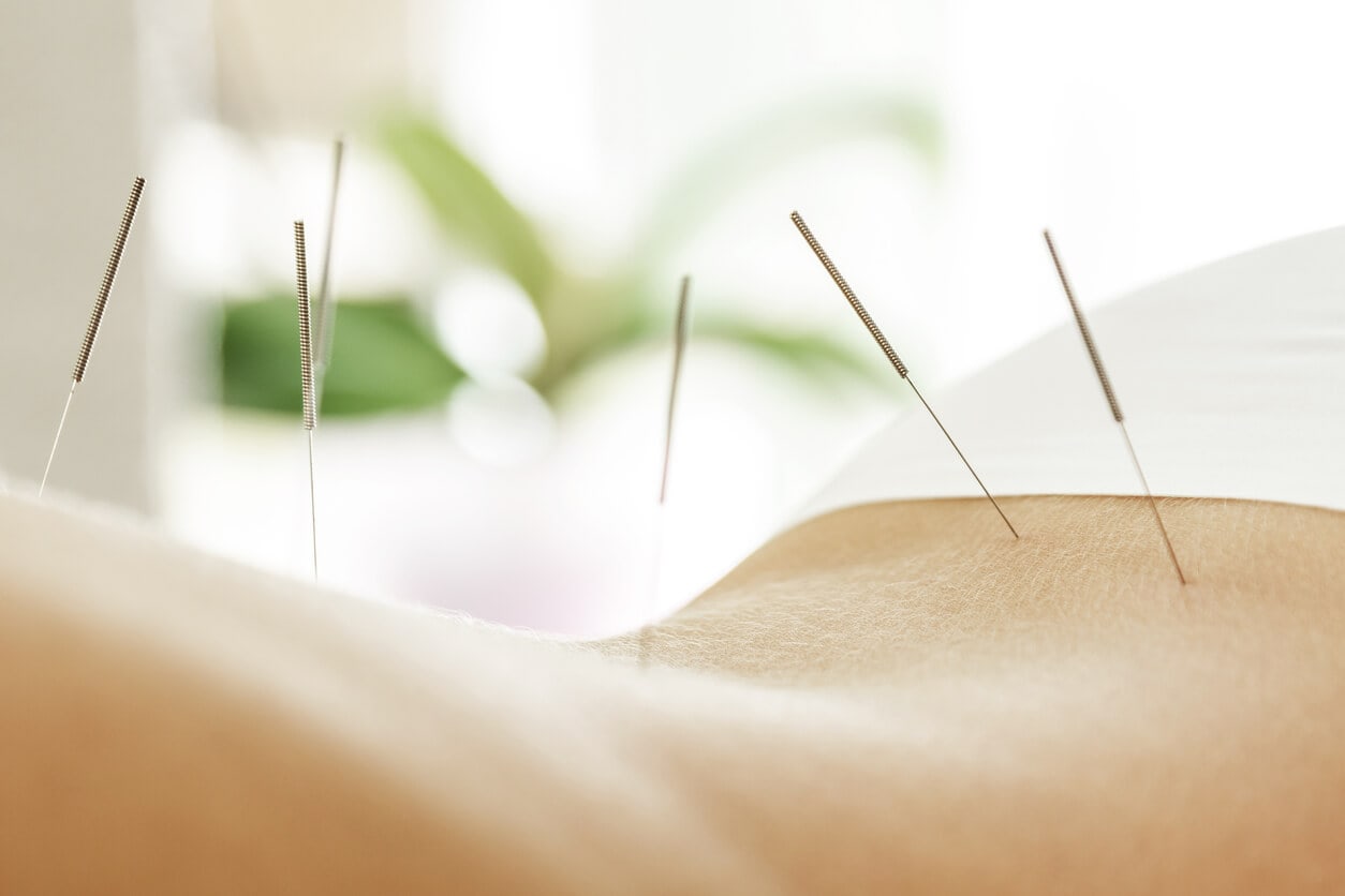 acupuncture pain management